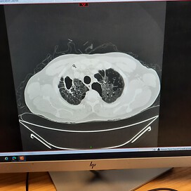 CT scan confirming severe emphysema 