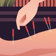 A woman getting acupuncture