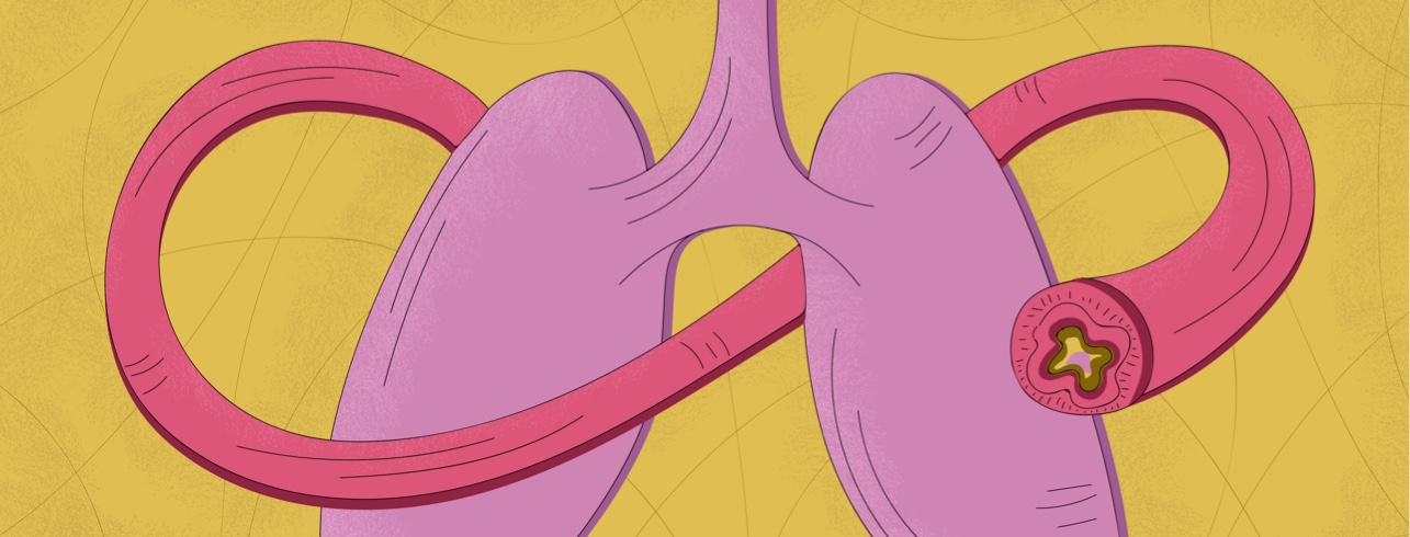 A restricted airway filled with mucus wrapping around a pair of lungs
