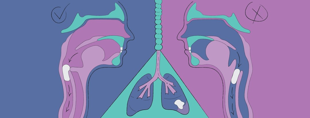 three anatomic drawings of someone swallowing, aspirating, and choking