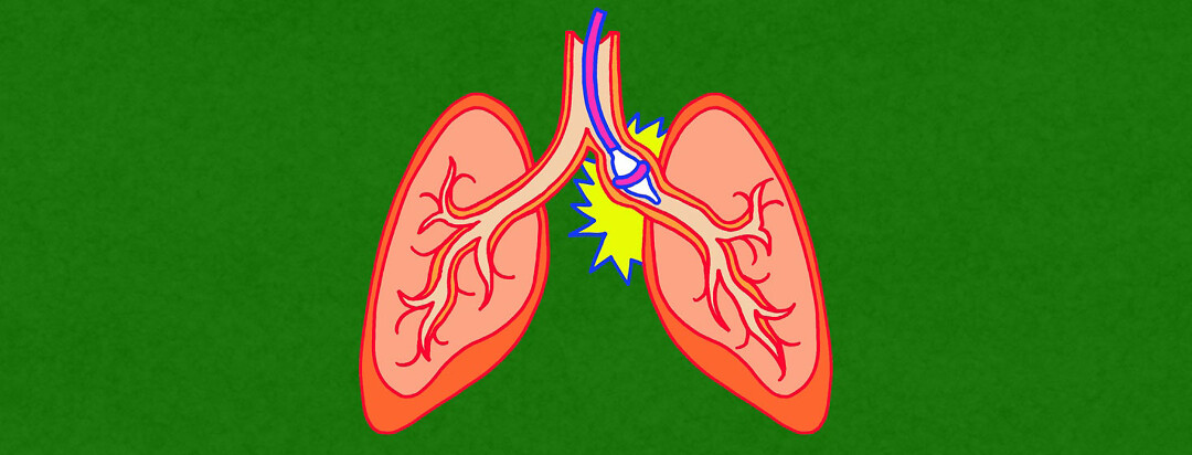 clinical image of a targeted lung denervation