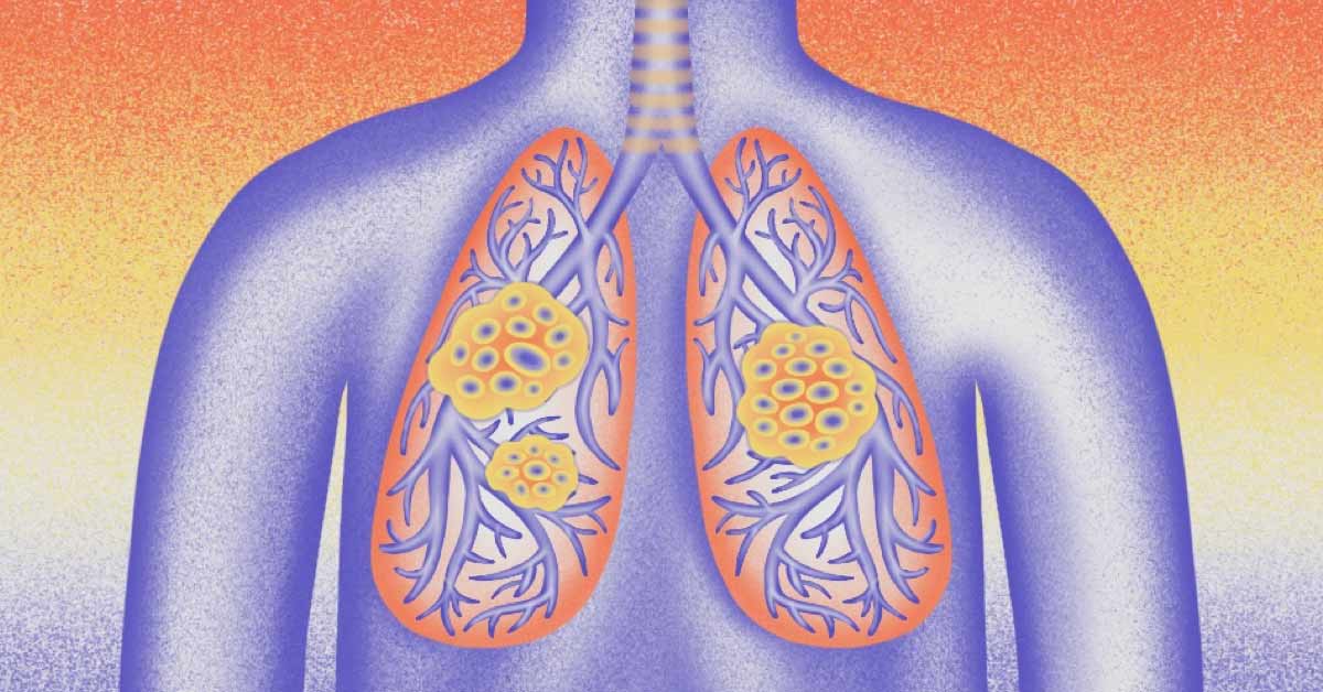 Lung nodules inside of a body