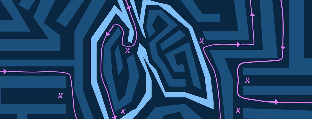 Am I a Candidate for Zephyr Valves? What You Should Know image